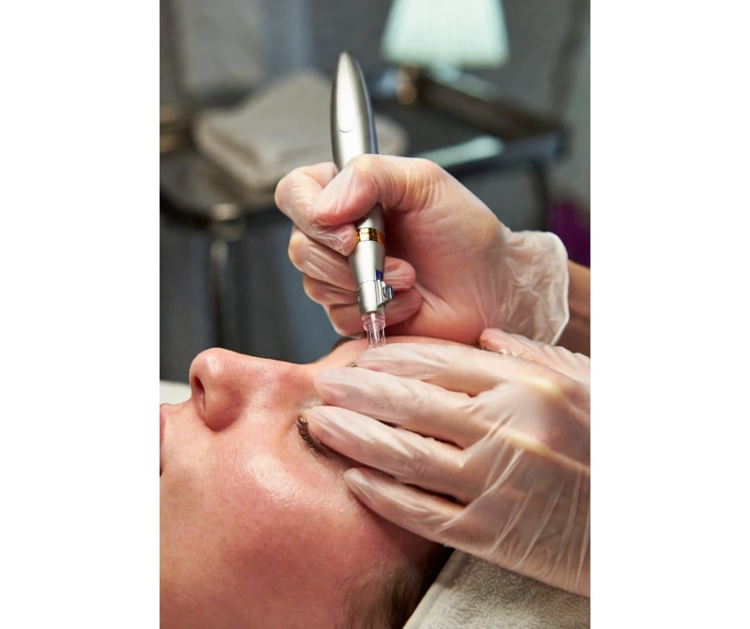 Kintsugi Estética Avanzada - Tratamiento despigmentante TranexWhite + Microneedling